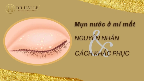 Mụn nước ở mí mắt: Nguyên nhân, triệu chứng và cách điều trị hiệu quả?