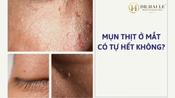 Dr.Hải Lê giải đáp: Mụn thịt mọc ở mí mắt có tự hết không?