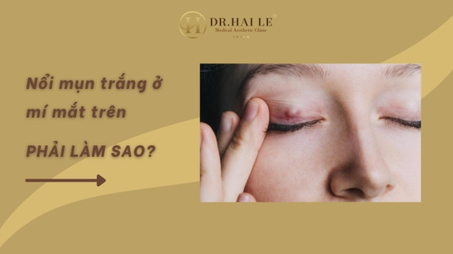 Chuyên gia giải đáp: Nổi mụn trắng ở mí mắt trên phải làm sao?