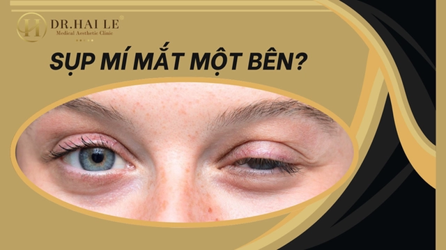 Sụp mí mắt 1 bên nghiêm trọng hơn bạn nghĩ rất nhiều!