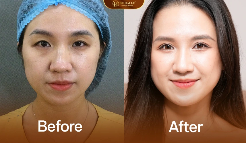 Ảnh trước sau khách hàng sau khi thực hiện cắt mí A.I Nano Matrix Deep tại Dr. Hải Lê