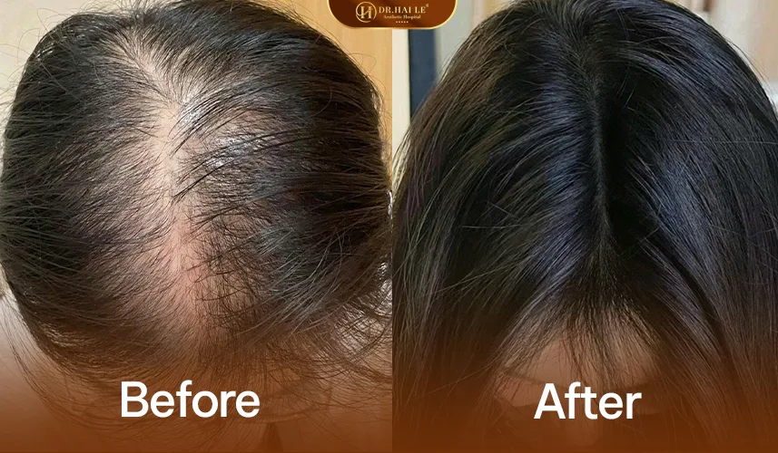 Phác đồ điều trị rụng tóc cá nhân hóa theo từng tình trạng da đầu
