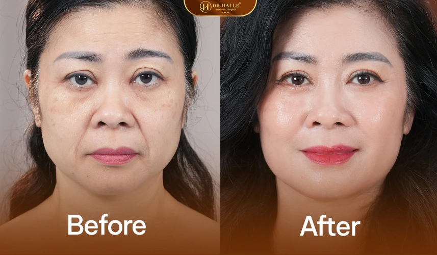 Nâng Cơ Thermage 4 Trẻ hóa tự nhiên với Thermage – không đơ cứng, không đổi biểu cảm