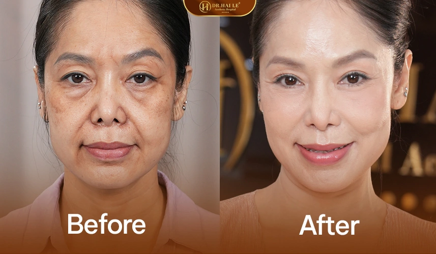 Làn da săn chắc, gọn gàng và trẻ trung hơn sau liệu trình nâng cơ