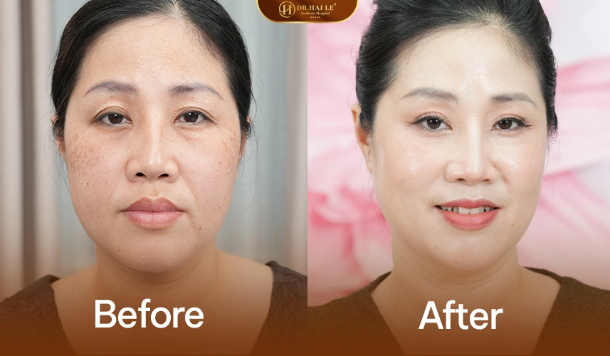 Nâng Cơ Ultraformer III 4 Hiệu quả nâng cơ Ultraformer III: da săn chắc, gọn gàng và trẻ trung hơn