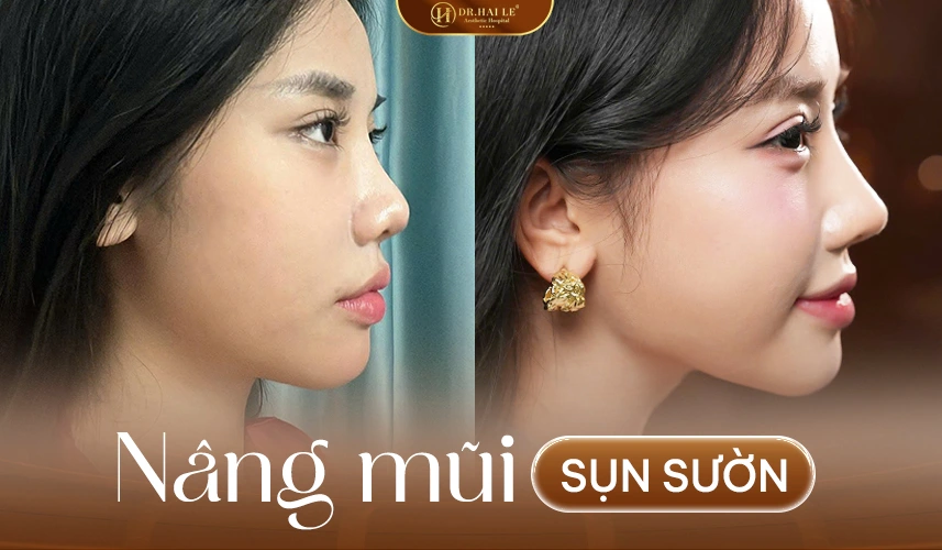 Nâng Mũi Cấu Trúc Sụn Sườn 4 Nâng mũi sụn sườn là giải pháp an toàn cho khách hàng da mũi mỏng, giúp dáng mũi cao tự nhiên