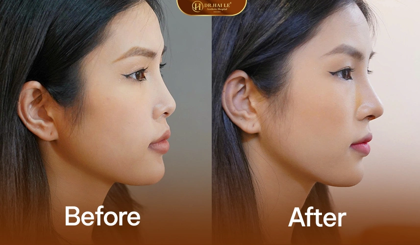 Kết quả nâng mũi Demi 5D: dáng mũi tự nhiên, thanh thoát, không lộ chỉnh sửa