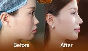 Nâng Mũi Cấu Trúc Medi-Form 5 Ảnh trước – sau nâng mũi cấu trúc Medi-Form: hài hòa, thanh tú, không lộ can thiệp