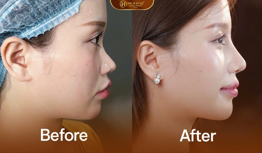 Nâng Mũi Cấu Trúc Medi-Form 4 Ảnh trước – sau nâng mũi cấu trúc Medi-Form: hài hòa, thanh tú, không lộ can thiệp