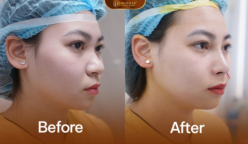 Thu Nhỏ Đầu Mũi 4 Đầu mũi thon gọn, có đỉnh rõ sau hồi phục, dáng mũi hài hòa và tự nhiên theo thời gian