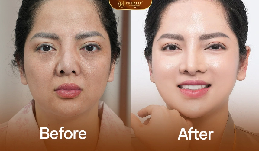 Da mịn màng, đều màu và tươi sáng hơn sau liệu trình Medi-RBA