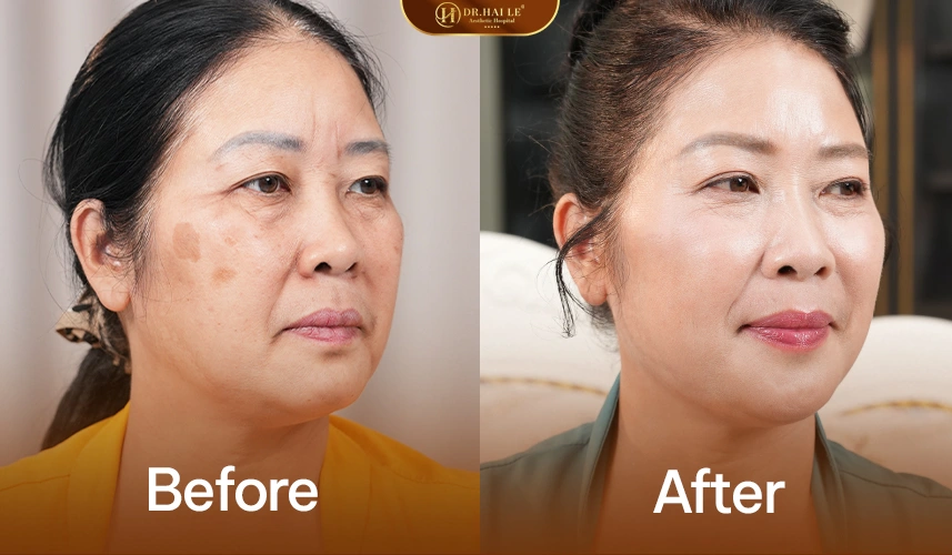 Cải thiện sắc tố da và dấu hiệu lão hóa một cách tự nhiên