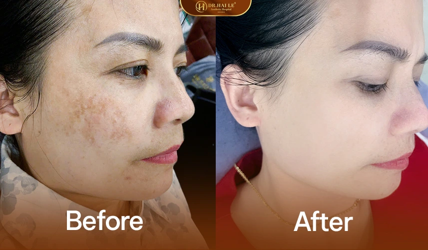 So sánh trước – sau trị nám PicoSure Pro cho thấy sắc tố giảm rõ và da đều màu hơn