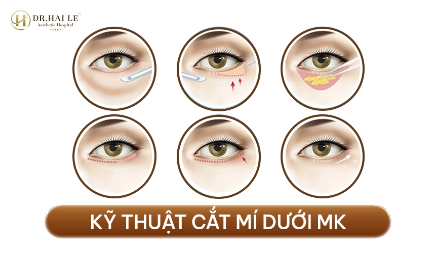 Phương pháp cắt mí dưới MK giúp mí dưới phẳng mịn, trẻ trung tự nhiên