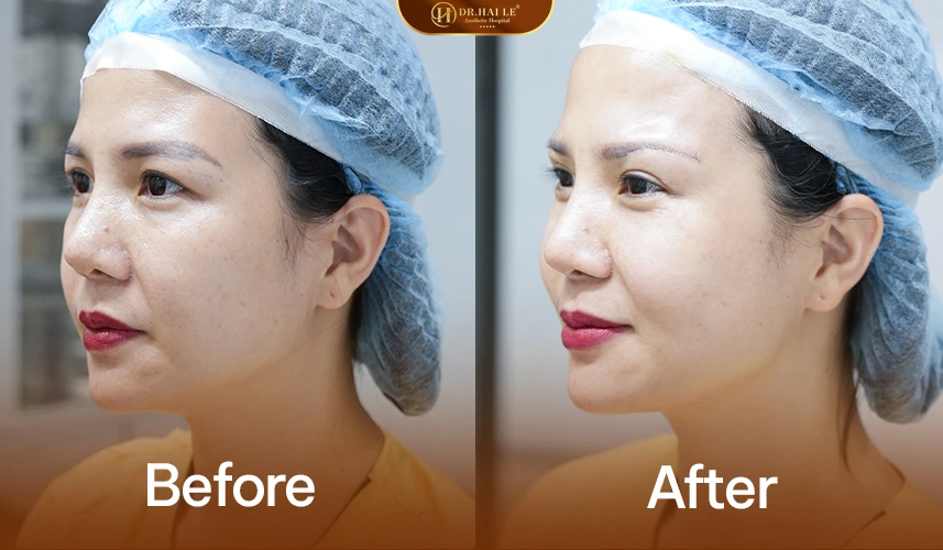Kết quả nâng cung mày cho người trung niên – ánh nhìn tươi sáng, tự nhiên