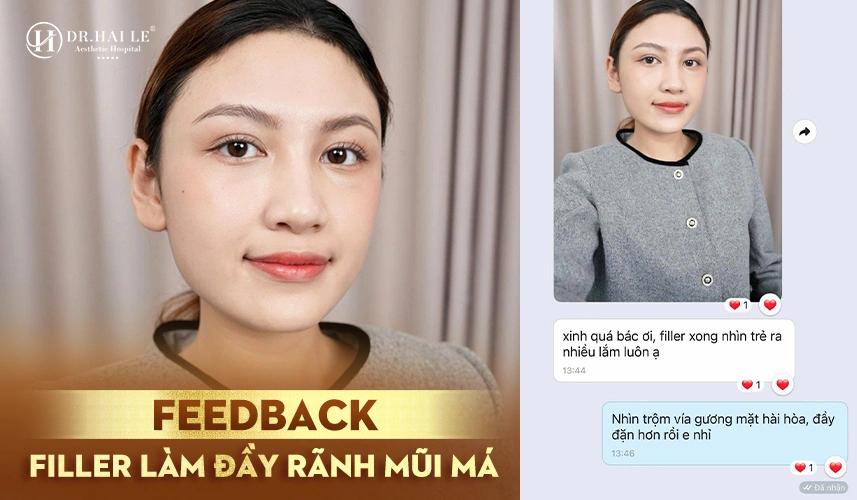 Hiệu quả làm đầy và trẻ hóa gương mặt rõ rệt sau tiêm