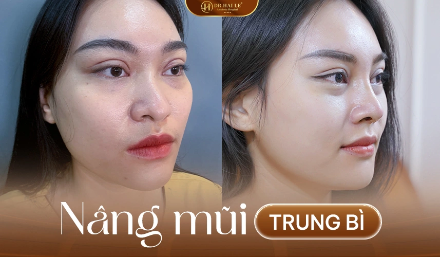 Kết quả nâng mũi trung bì: mũi mềm mại, tự nhiên, ổn định