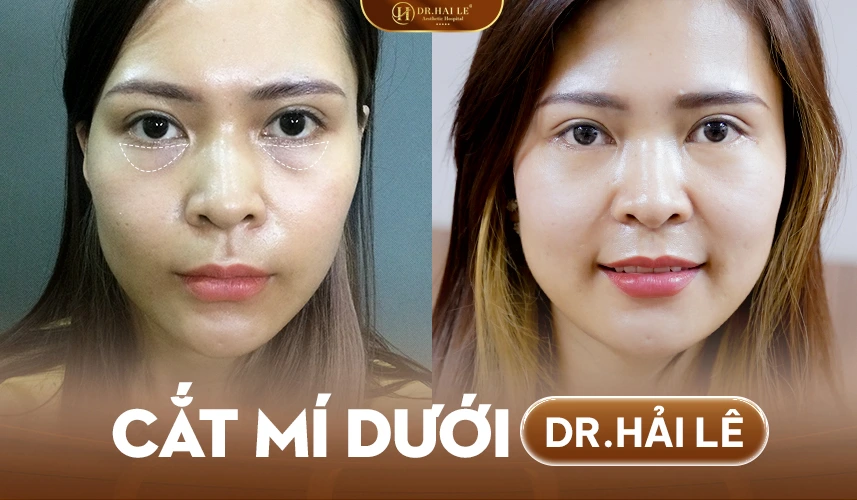 Thiết kế phác đồ cắt mí dưới MK cá nhân hóa theo từng cấu trúc mắt