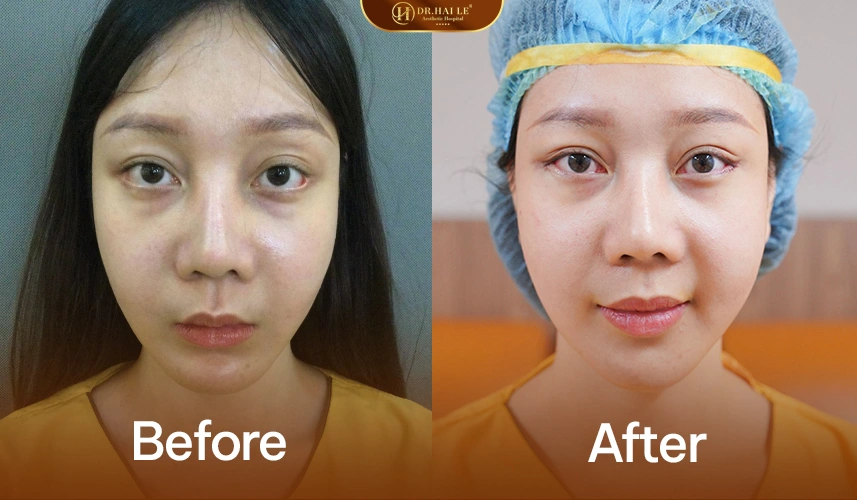 Deep Tech Repair mí dưới – Giải pháp y khoa cho các ca mí dưới khó và lão hóa nặng