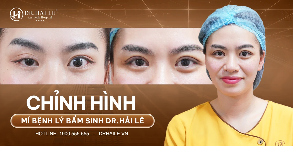 Chỉnh hình mí bệnh lý sụp bẩm sinh