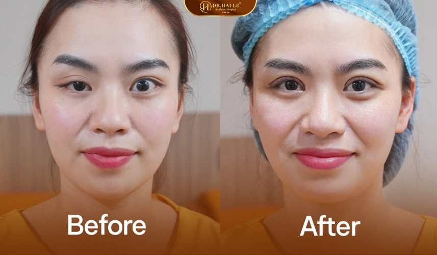 Chỉnh hình mí bệnh lý sụp bẩm sinh giúp cải thiện thị lực và thẩm mỹ lâu dài.