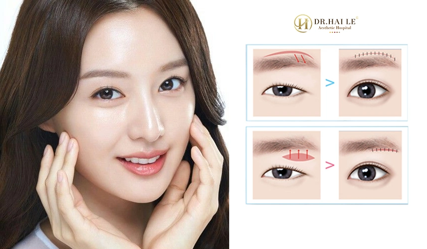 Phân tích tỷ lệ nhân trắc học vùng mày – mắt trước nâng cung mày chuẩn y khoa