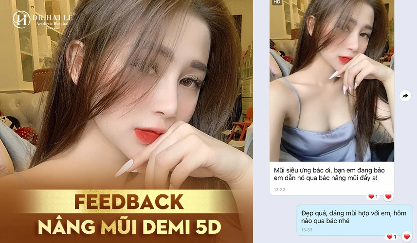 Nâng mũi Demi 5D giúp gương mặt hài hòa và tinh tế ở góc nhìn chính diện