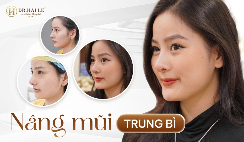 Dáng mũi trung bì tự nhiên, mềm mại – phù hợp da mũi mỏng