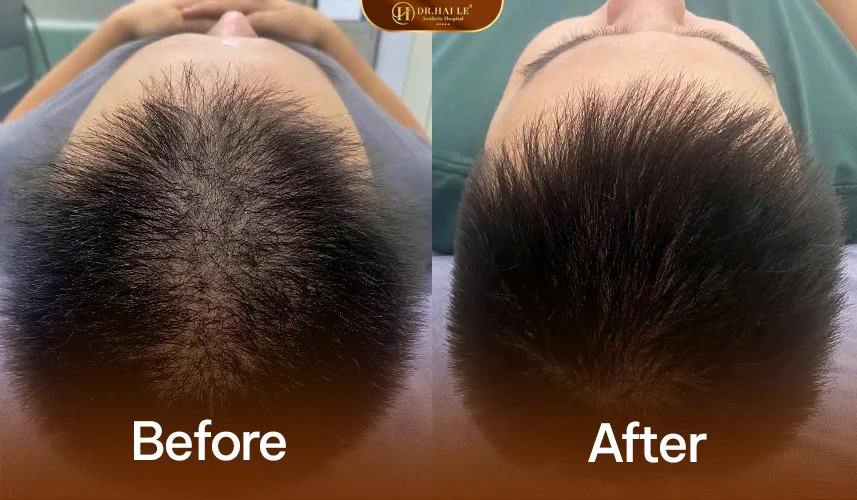Phác đồ điều trị rụng tóc cá nhân hóa theo từng tình trạng da đầu