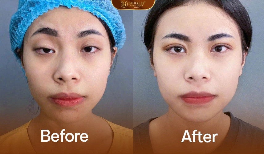 Phẫu thuật chỉnh hình mí bệnh lý trong phòng mổ vô khuẩn chuẩn y khoa