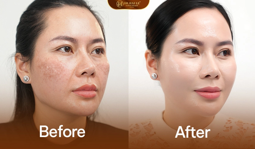 Quy trình trẻ hóa da được cá thể hóa theo từng độ tuổi và tình trạng da