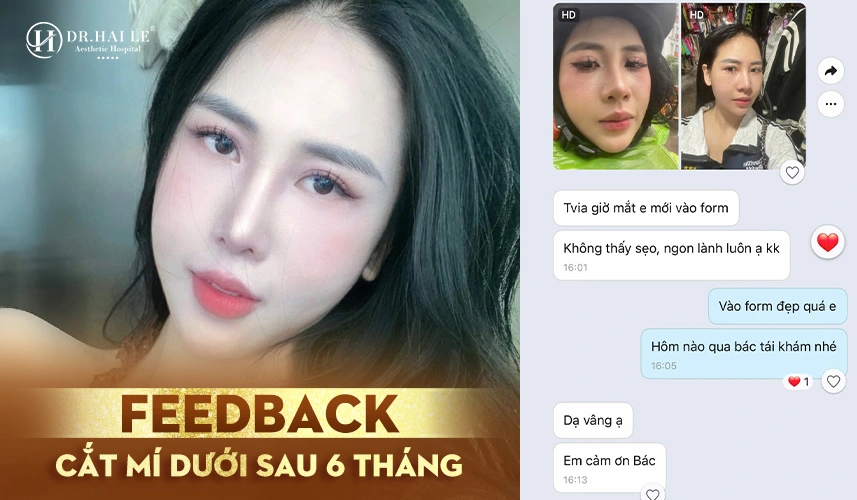 Hình ảnh trước và sau cắt mí dưới MK – cải thiện bọng mỡ và rãnh lệ