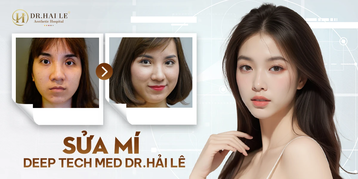 Sửa mí Deep Tech Med tại Bệnh viện Thẩm mỹ Dr.Hải Lê là kỹ thuật y khoa chuyên sâu, được nghiên cứu dành riêng cho những trường hợp mí mắt tổn thương nặng
