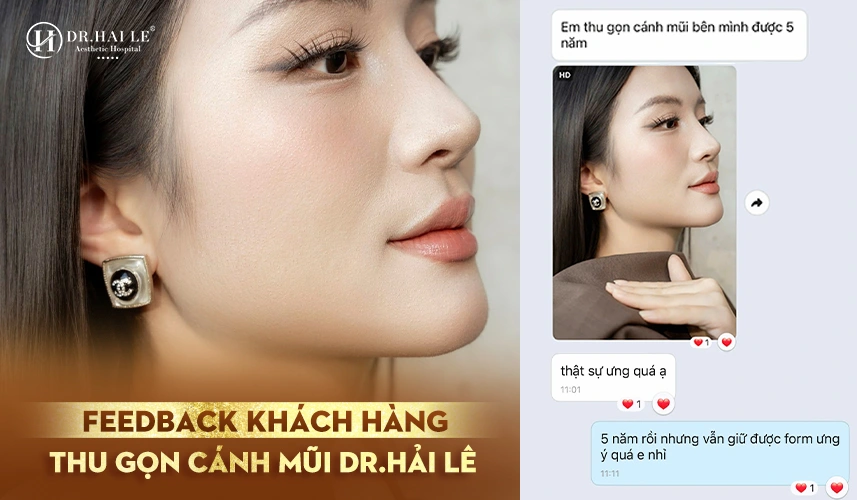 Thu Gọn Cánh Mũi 2 Thu gọn cánh mũi giúp dáng mũi thon gọn, hài hòa tổng thể gương mặt