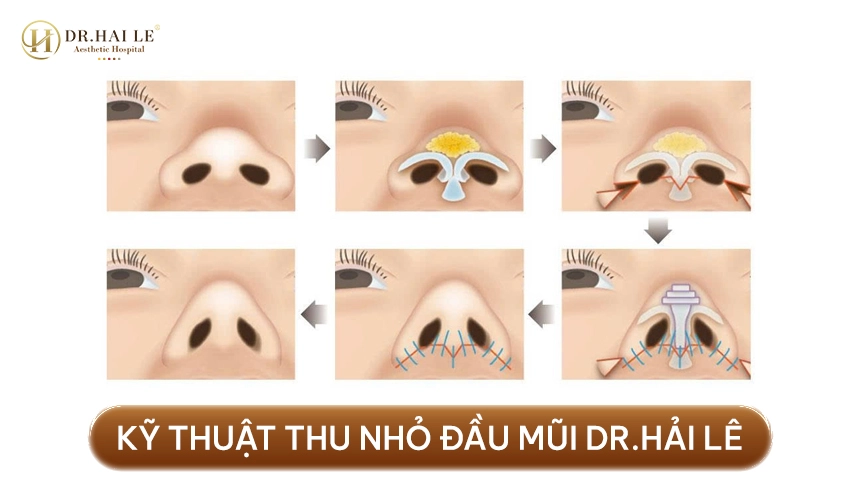 Thu Nhỏ Đầu Mũi 2 Thu nhỏ đầu mũi giúp chóp mũi thon gọn, có đỉnh rõ, hài hòa tổng thể dáng mũi