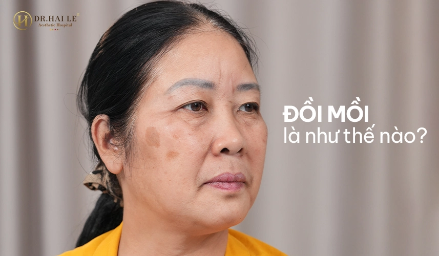 Các đốm đồi mồi xuất hiện phổ biến tại vùng da mặt, tay và cổ