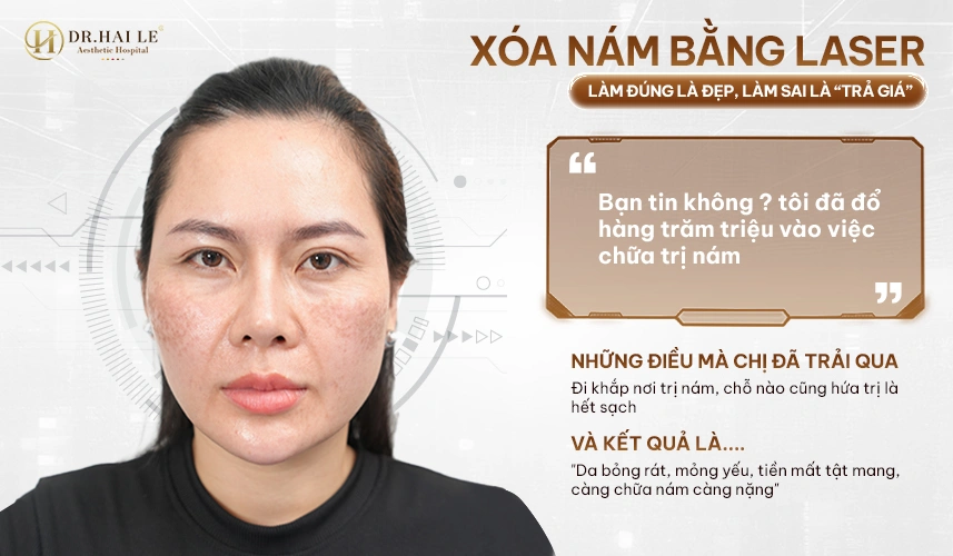 Trị nám không bong tróc – không xâm lấn – không cần nghỉ dưỡng, phù hợp khách hàng bận rộn