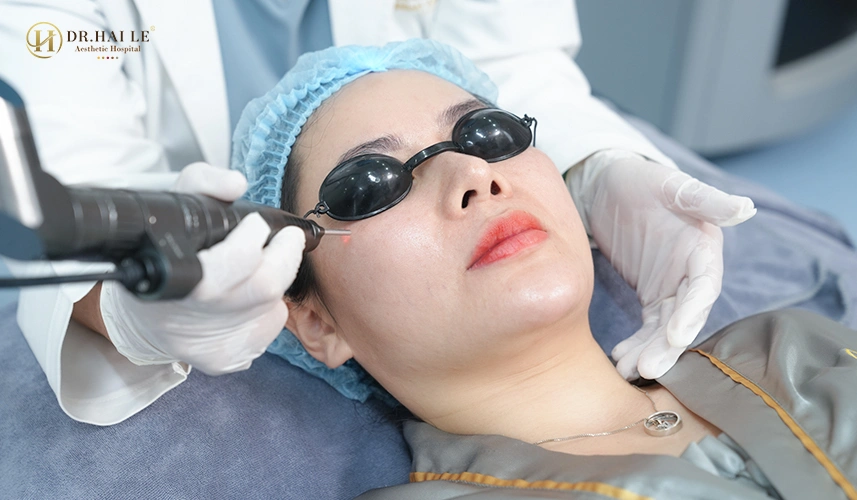 Trị Tàn Nhang Hollywood Spectra 2 Công nghệ laser hiện đại hỗ trợ điều trị tàn nhang nông và chân sâu
