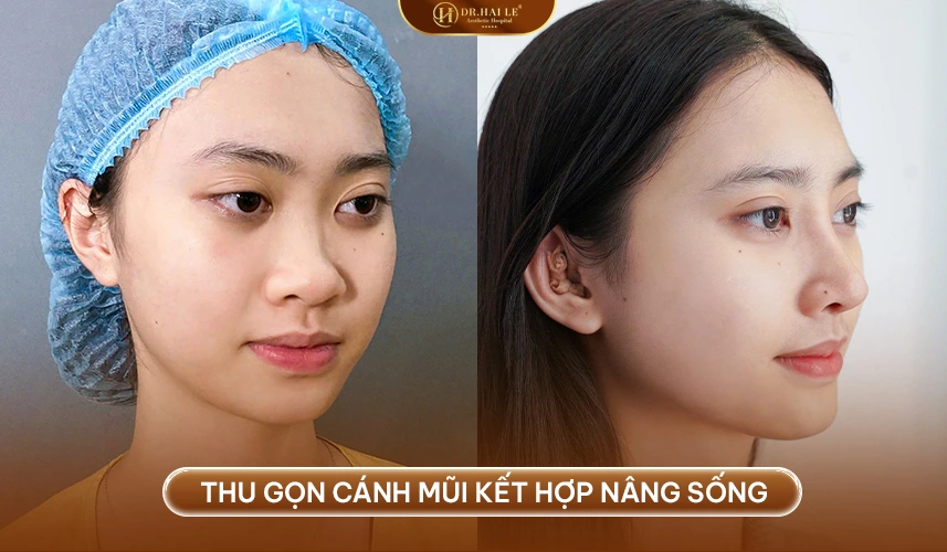 Thu Gọn Cánh Mũi 3 Kết quả thu gọn cánh mũi duy trì bền vững khi thực hiện đúng kỹ thuật