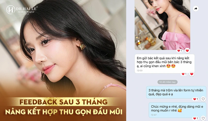 Thu Nhỏ Đầu Mũi 3 Đầu mũi thanh gọn, độ nhô tự nhiên, tạo đường nét mềm mại cho khuôn mặt