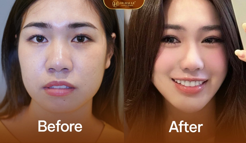 So sánh trước – sau độn cằm: đường viền hàm – cằm rõ nét, cân đối hơn
