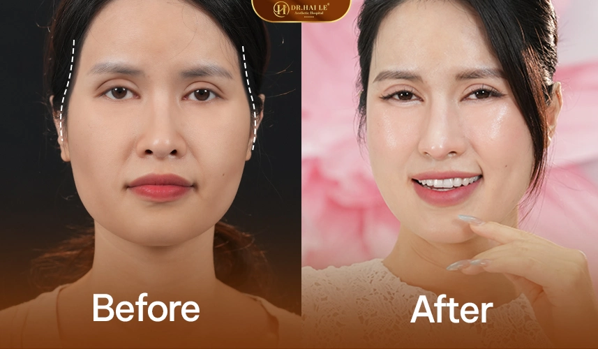 Trước – sau độn vùng trên gò má: gương mặt đầy đặn hơn, ánh nhìn tươi tắn