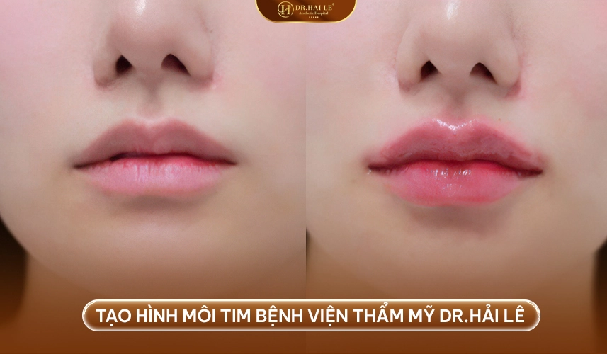 So sánh trước – sau tạo hình môi trái tim: cải thiện rõ đường viền và độ cân đối môi