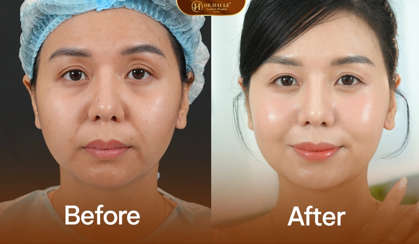 Trước & sau tạo hình nhân trung: môi trên cân đối – nụ cười mở