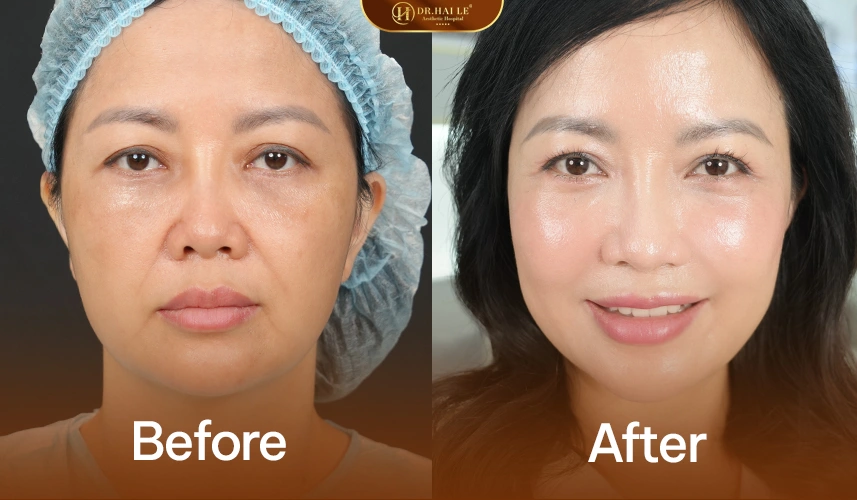 Thẩm mỹ độn hố lê – hoàn thiện đường viền cằm hài hòa