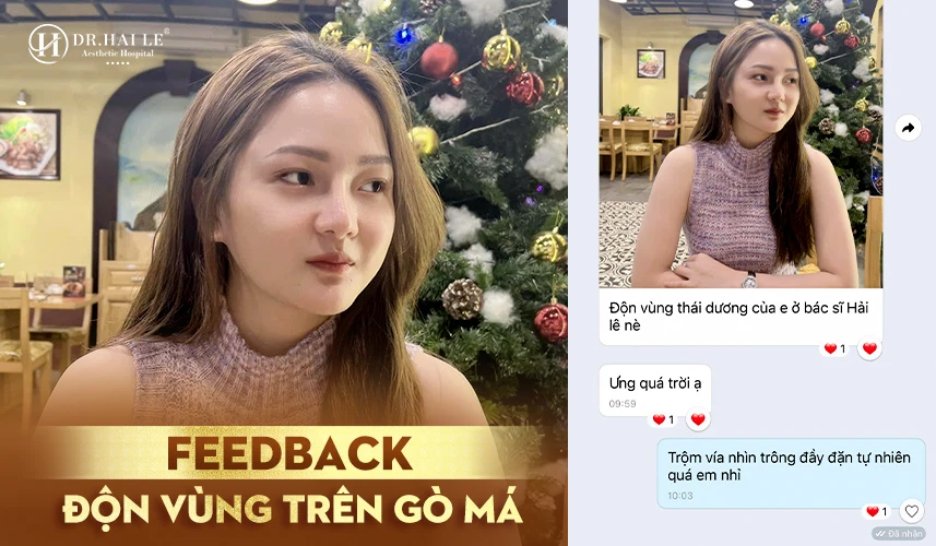 Độn vùng trên gò má giúp cải thiện tình trạng gò má hóp, mắt sâu, khuôn mặt mệt mỏi