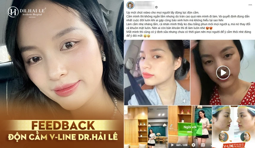 Cải thiện rõ tình trạng cằm lẹm, cằm ngắn – gương mặt thanh thoát hơn sau độn cằm