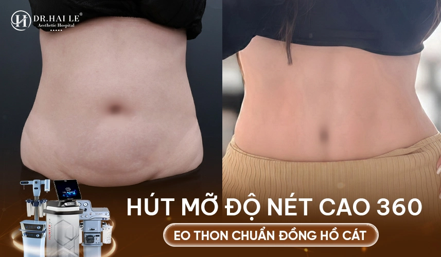 So sánh trước và sau hút mỡ: giảm số đo rõ rệt, form dáng gọn gàng và tự nhiên theo từng cơ địa.