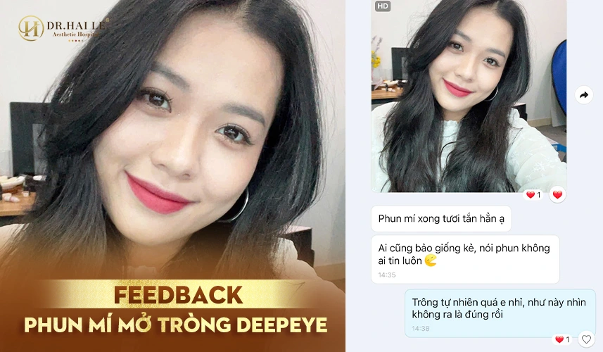 Trước & sau phun mí: mắt rõ nét – ánh nhìn cuốn hút