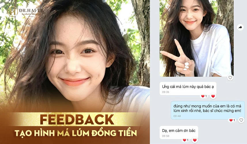 Má lúm nhẹ nhàng, tăng nét duyên và sự nữ tính cho nụ cười